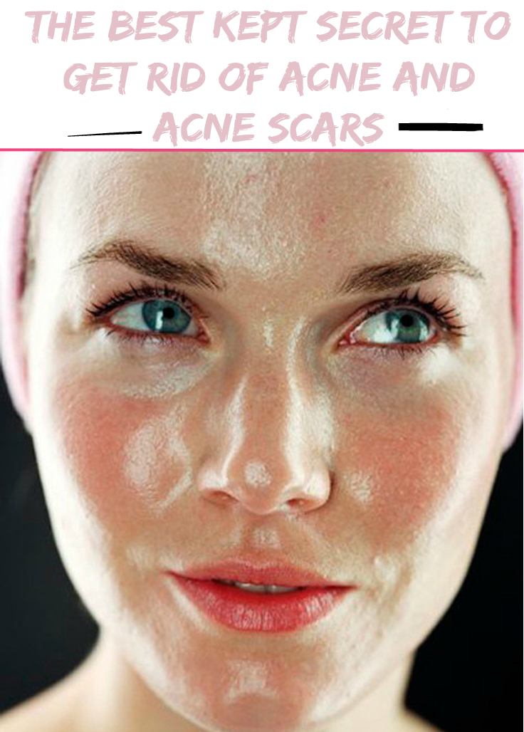 Women's Mag Blog: The best kept secret to get rid of acne and acne