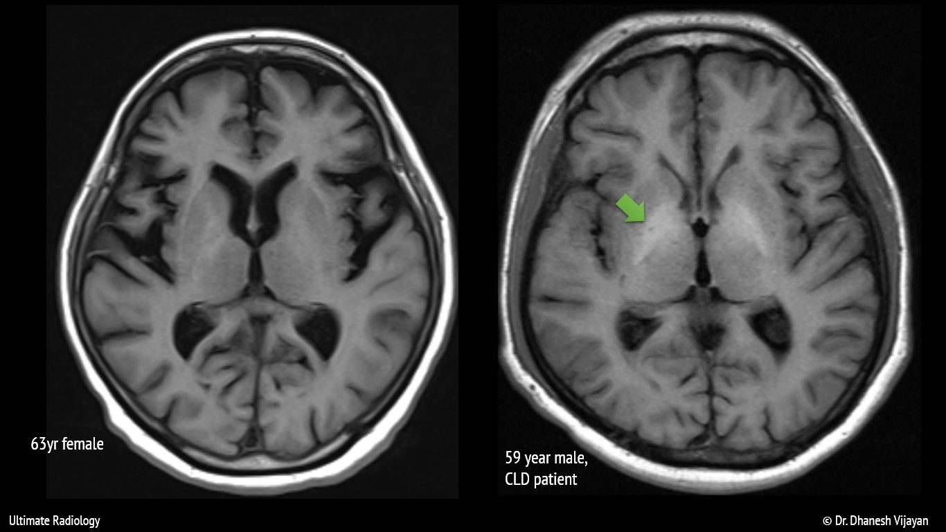 Ultimate Radiology Bilateral basal ganglia T1 hyperintensity