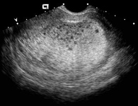 Bila UptTest Mula Positif: INFO : Molar Pregnancy @ Kandungan Anggur