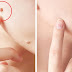 Moles and Skin Tags: Causes And How to Avoid Them