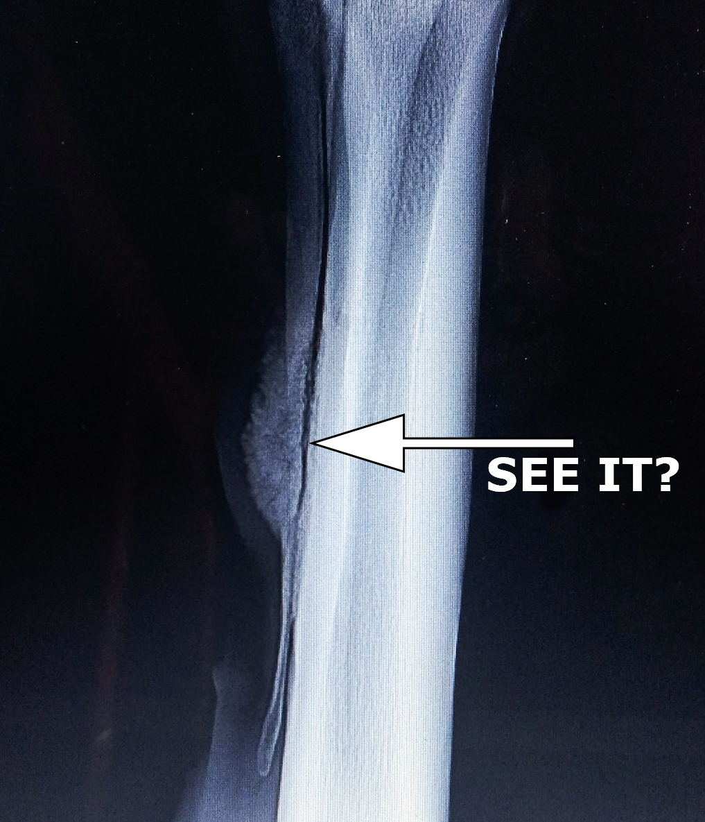 Ending the season with a break... of bone