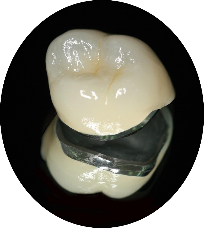 Odontology Student Prosthodontics The MetalCeramic Crown Preparation PART 1