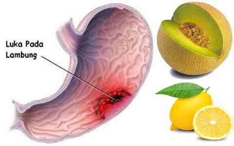 Ternyata Melon Dan Lemon Sangat Ampuh Mengatasi Vertigo, Maag Akut, Migrain, dan Asam Urat