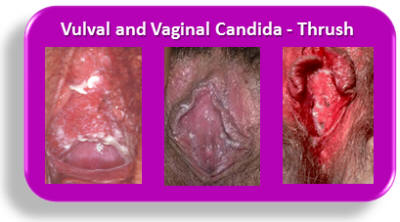 Darker skin in pubic, genital, rectum areas and between ...