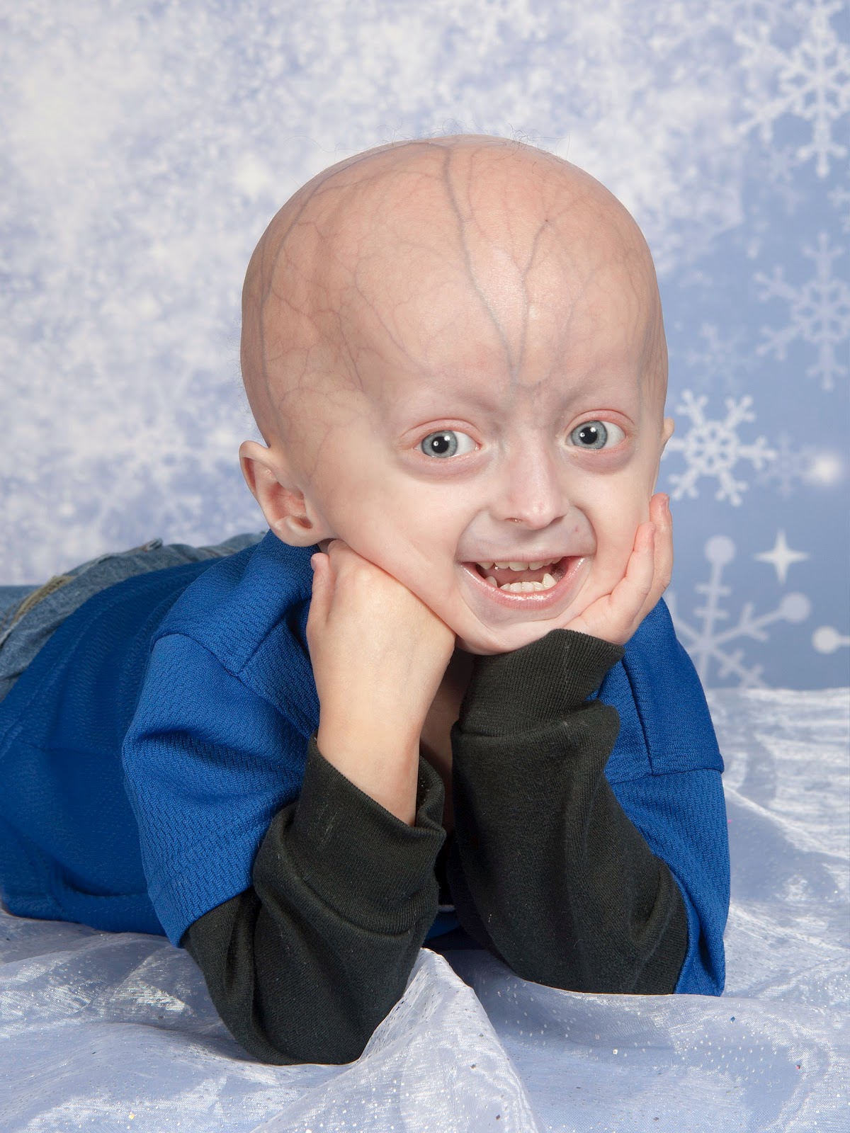 Progeria Disease, Rare Diseases in the World DaftSex HD