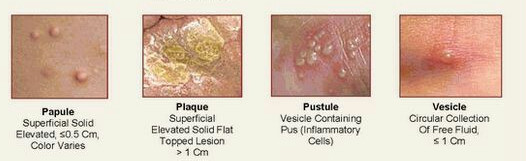 Type Of Skin Lesion | Did You Kn0w it