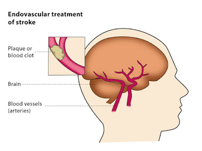 http://www.thebrainandspine.com/thrombolytic-therapy-for-stroke/