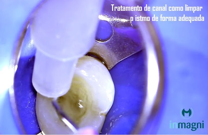 ENDODONTIA: Tratamento de canal como limpar o istmo de forma adequada - Angelo Freire