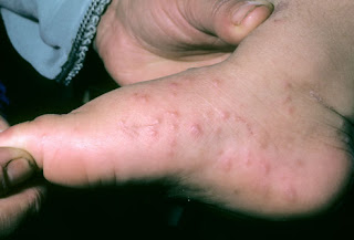 hand foot and mouth, spots on feet childhood rash 