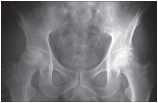 Paciente con Osteonecrosis en ambas caderas en estado temprano. Fuente: Dr. Cruz