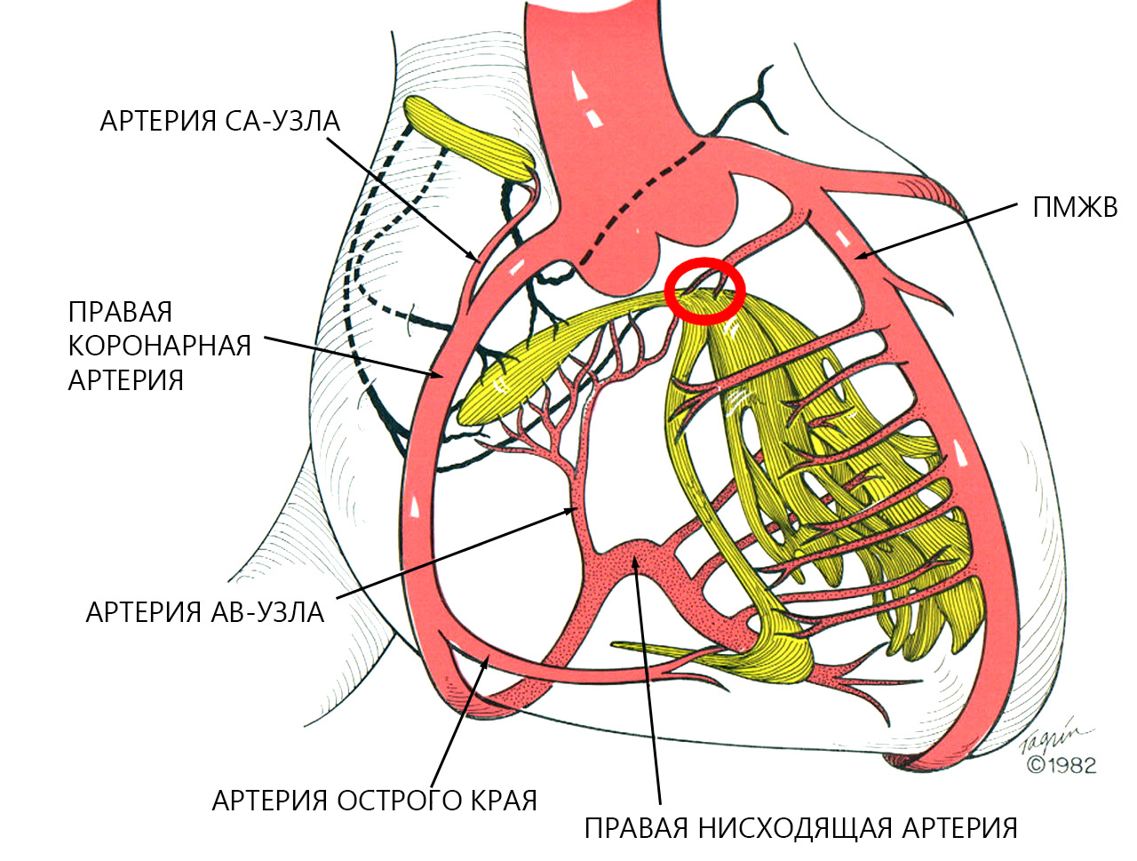 коронарография стеноз пмжв. коронарные артерии кровоснабжение стенок. пмжв. пмжв. диссекции коронарной артерии nhlbi.
