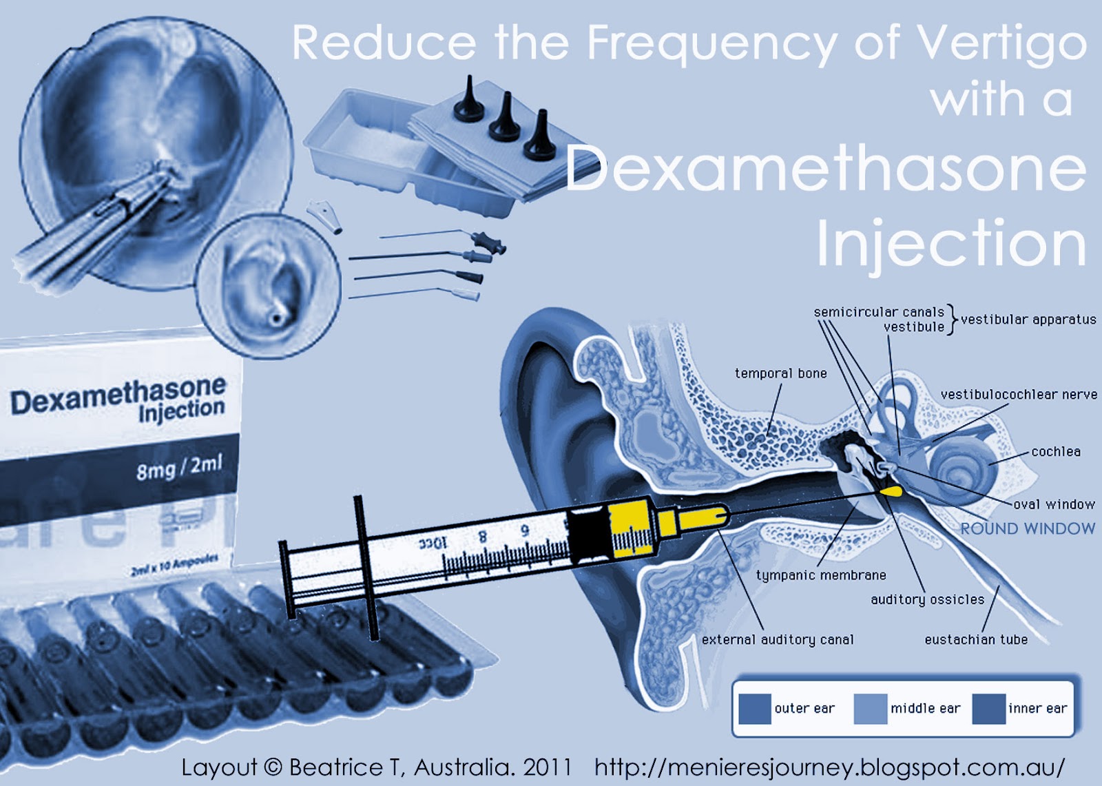 Menieres An Inner Ear Journey More On Intratympanic Dexamethasone