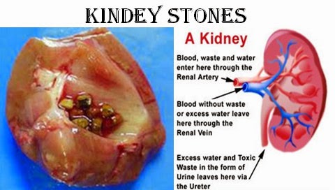 Foods Good For The Kidney Stones Foods Good For The Kidney Stones