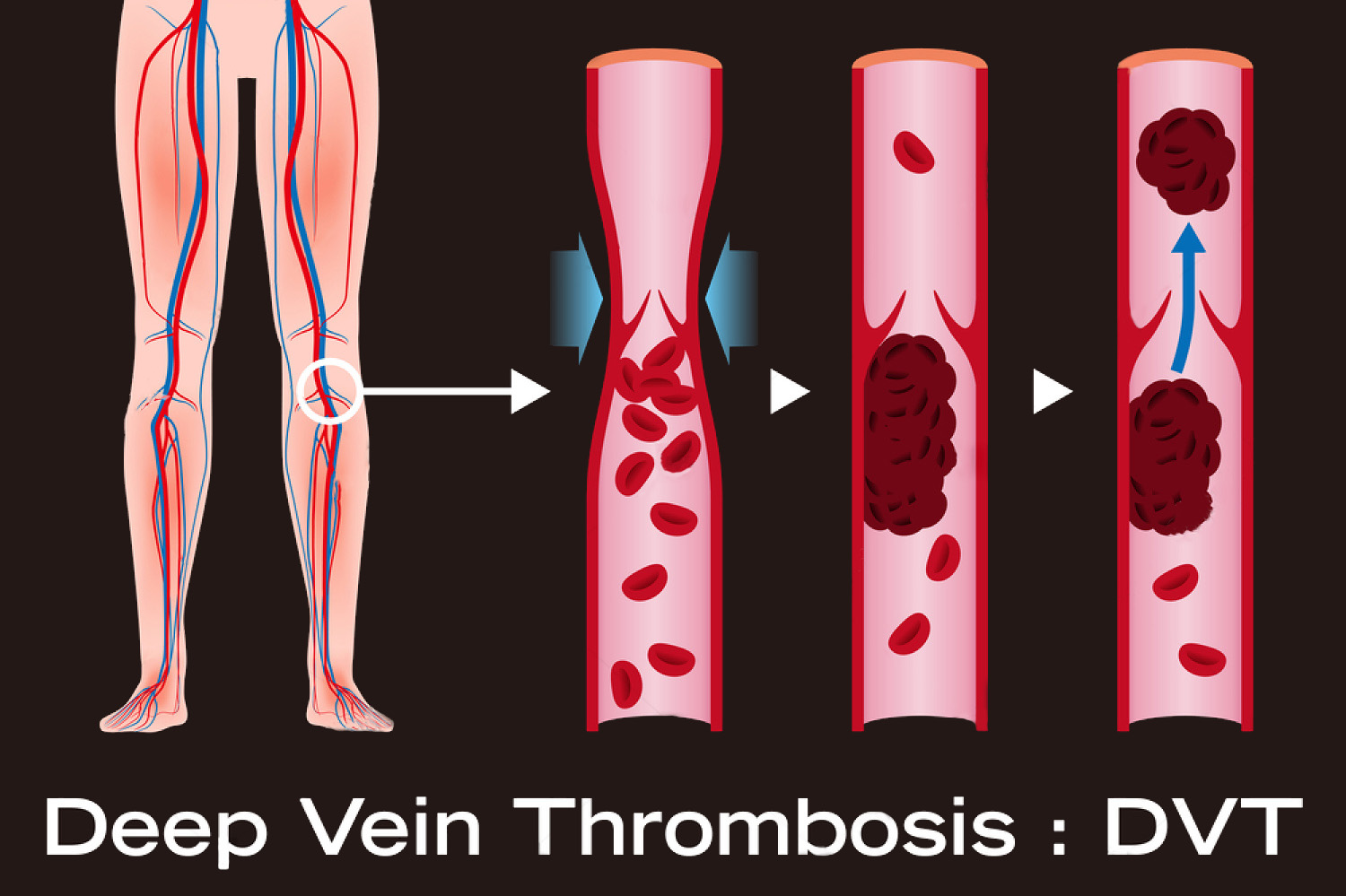 Dvt The Science Of Blood Clots