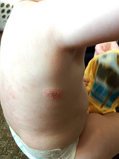 Infant Eczema Plaque