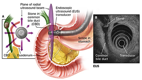 endoskopik-ultrasound-pada-obstruksi-biliaris