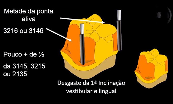 PRÓTESE FIXA: Preparo para Coroa Total Posterior passo a passo