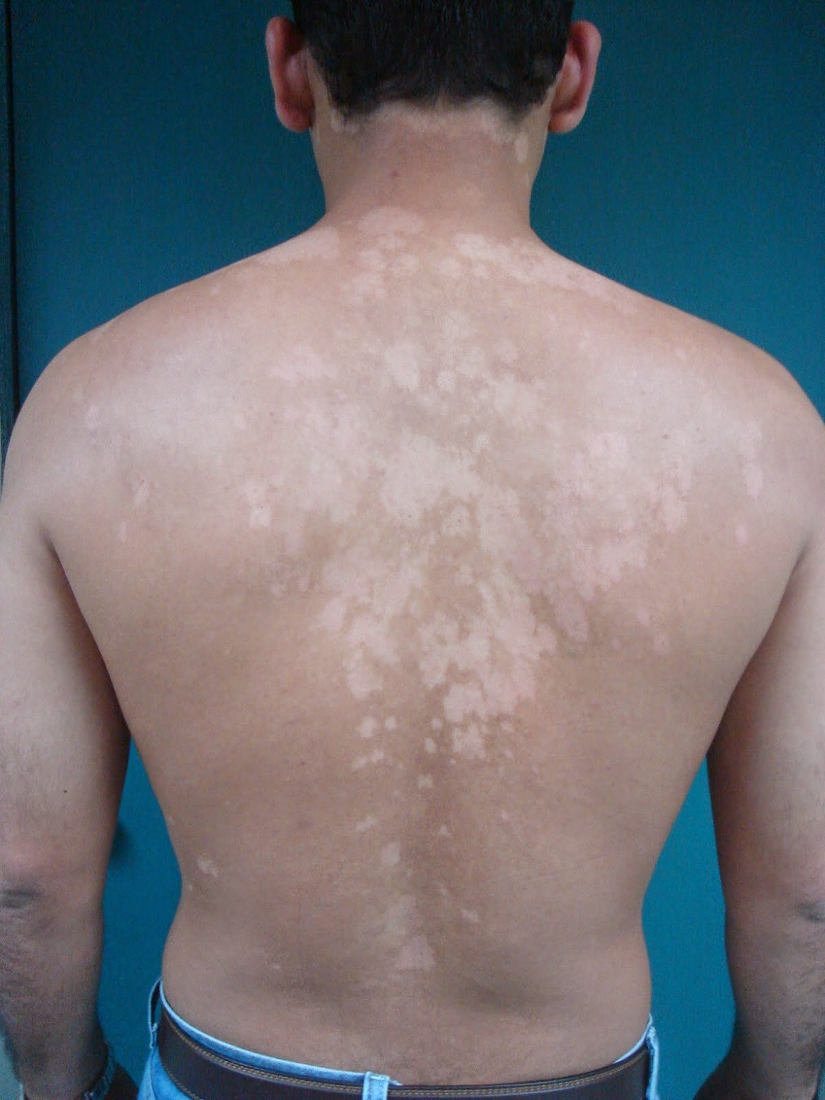 Cara Mengobati Penyakit Kulit Kutono