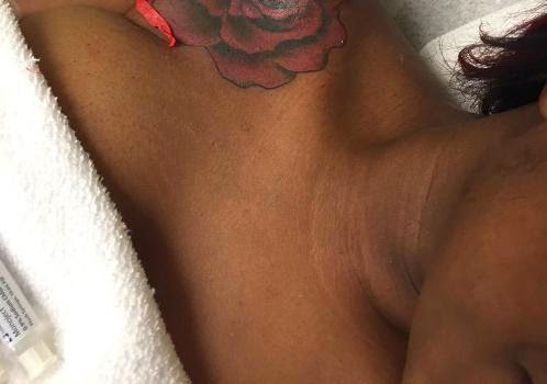 a Graphic photo: Unsterilised needle used by tattoo artist on a lady affects her skin