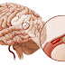 Bệnh tai biến mạch máu não là gì, nguyên nhân, cách phòng tránh