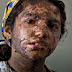 Afghan girls burn themselves to end forced marriages with abusive men
