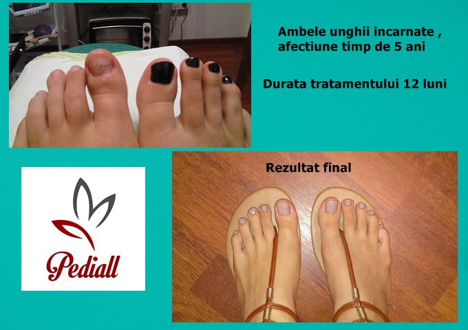 Pediall Unghie Incarnata Tratament 2016