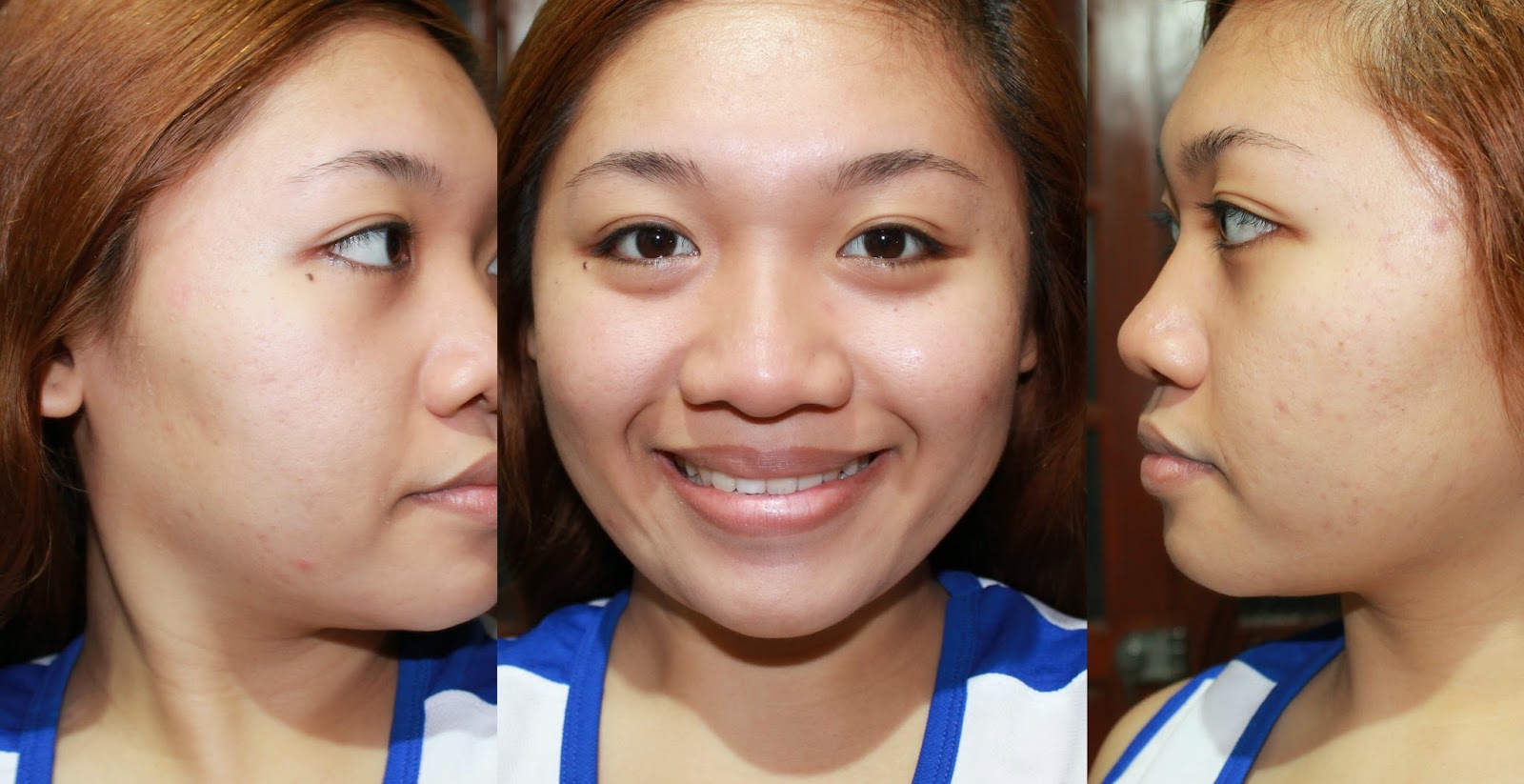 SKINMATE SHARK OIL REVIEW (How I Cleared My Acne)