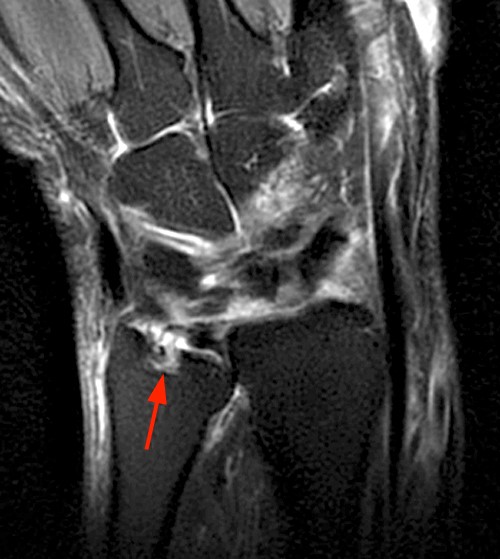 MRI MusculoSkeletal Section Rheumatoid arthritis of the wrist.