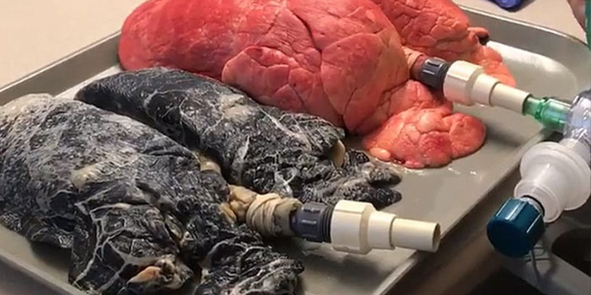 Video Demonstrates The Shocking Difference Between The Lungs Of Smokers And Non-Smokers