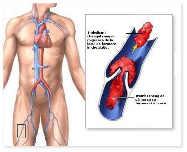 Tromboză venoasă profundă - Capital Associates Cardiologie