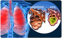 Acute Respiratory Distress Syndrome Acute Respiratory Distress Syndrome