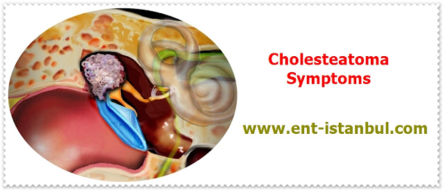 Cholesteatoma Symptoms