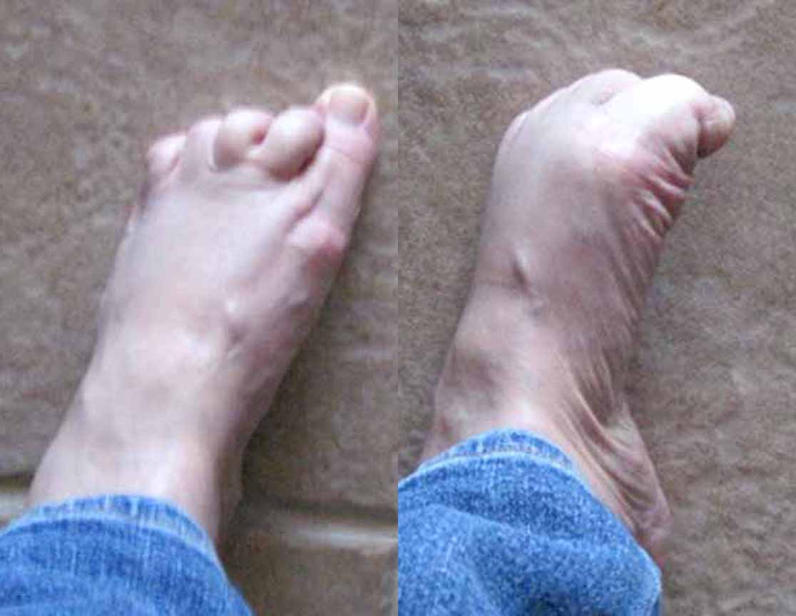 Muscle Spasm In Big Toe 59