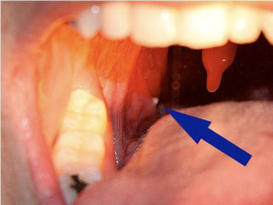 White Ball In Back Of Throat 106