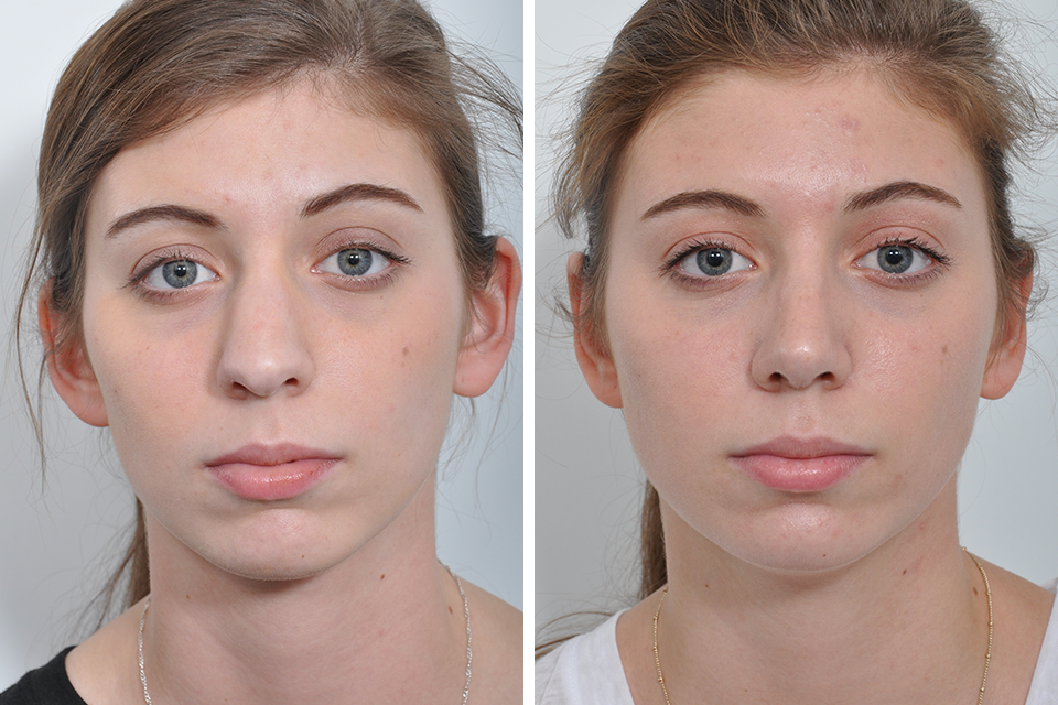 Is Rhinoplasty Nose Surgery Effective For A Crooked Nose?