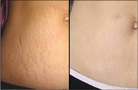 12 Rekomendasi Krim Anti Stretch Mark Untuk Menyamarkan Stretch Mark Bukareview
