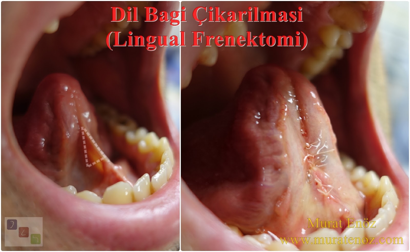 lingual frenectomy