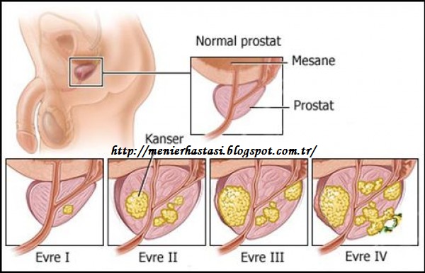 menier sendromu prostat kanseri nedir