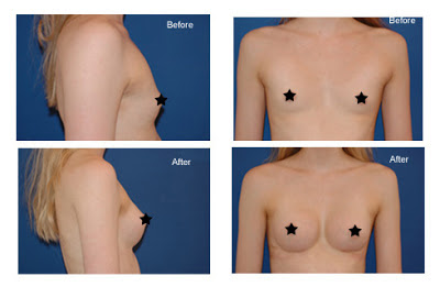 Antes e Depois Mamoplastia de Aumento Antes e Depois Mamoplastia de Aumento