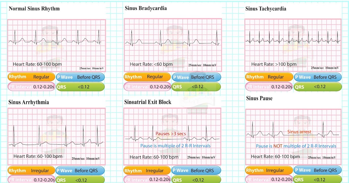 ECG Educator Blog : Sinoatrial Node rhythms