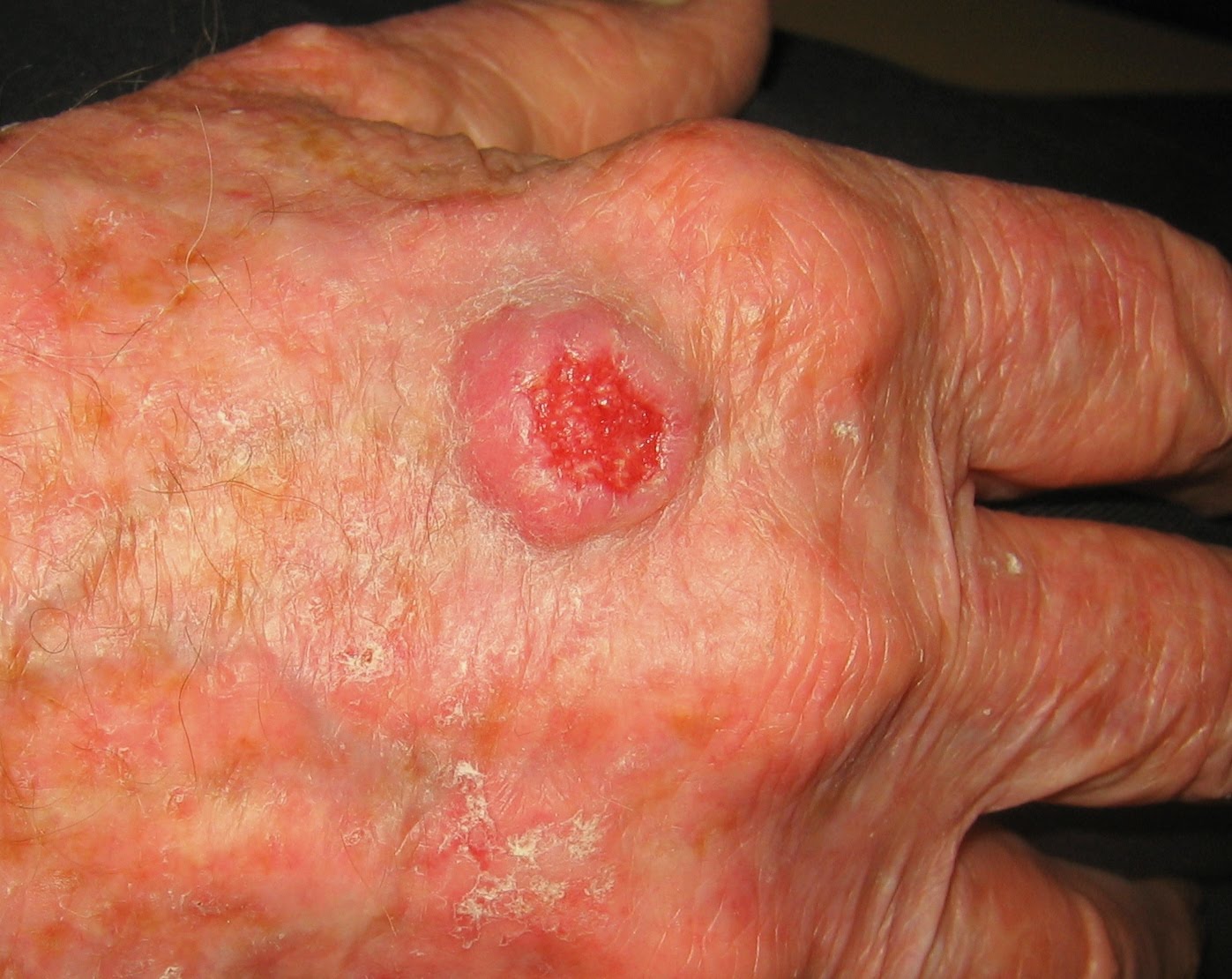 Pictures of Skin Cancers - Squamous Cell Carcinoma