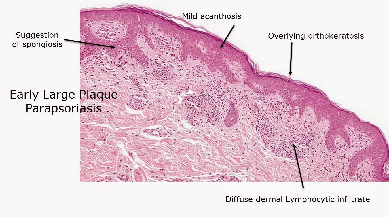 Dermatopathology Made Simple Inflammatory Psoriasiform Reaction Pattern