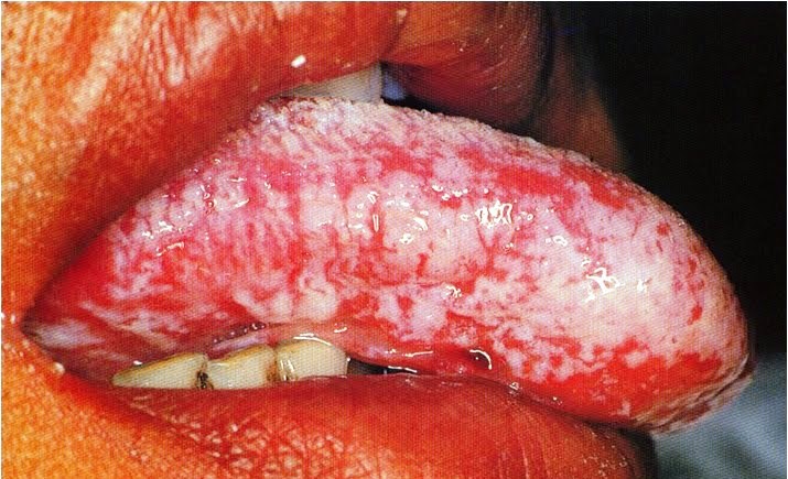  hairy leucoplakia, fungal infection in tongue, நாக்கில் வெள்ளை புள்ளிகள் சிகிச்சை, homeo treatment chennai, velachery