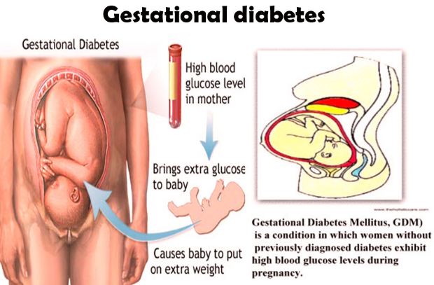 Gestational Diabetes Levels-What Does Gestational Diabetes Blood Sugar