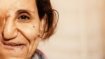 Separuh Wajahnya Hancur Akibat Bom: "Dokter Sudah Menyerah, Tapi Tuhan Punya Rencana"