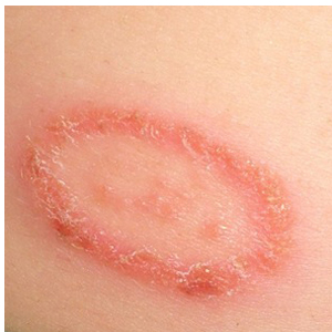 How to Identify and Treat Ringworm (with Pictures) - wikiHow