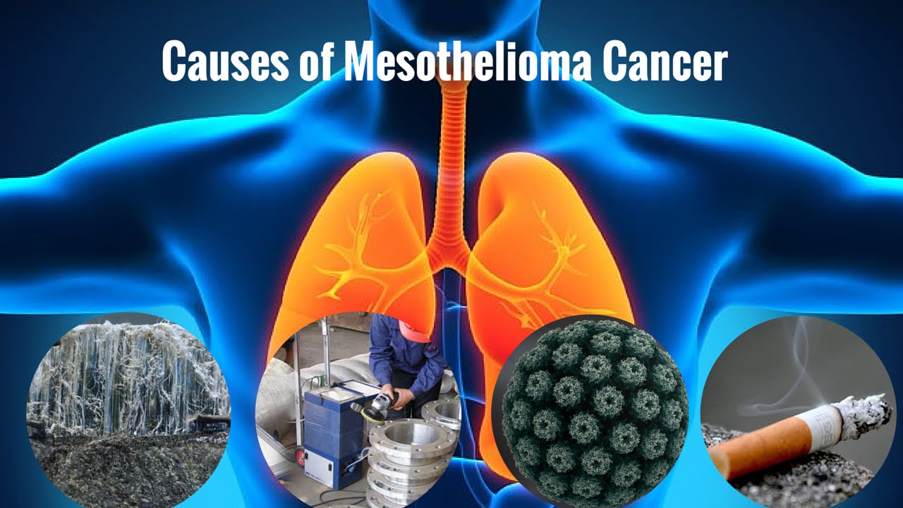 mesothelioma-cancer-causes-of-mesothelioma-cancer-readnews