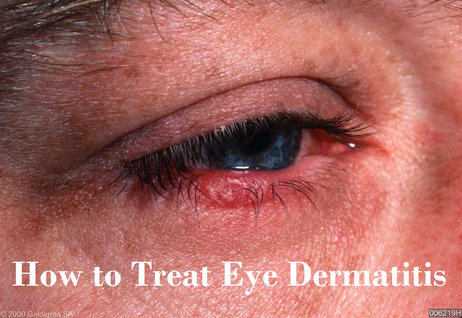 How to Treat Eye Dermatitis SkinnyZine
