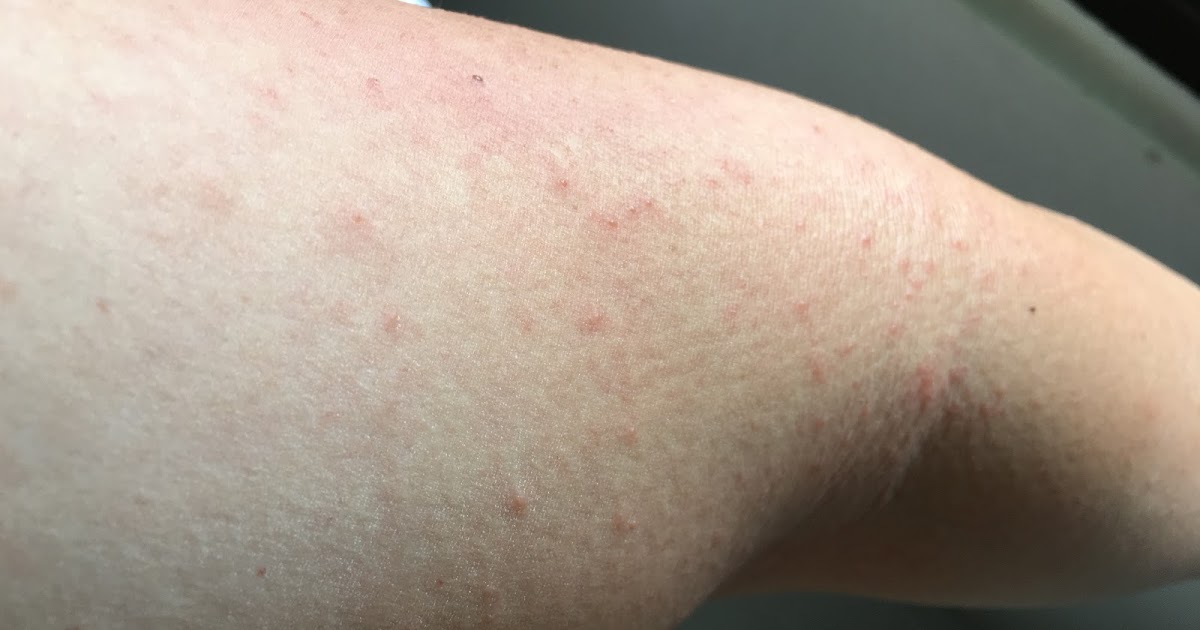 Super Itchy Rash