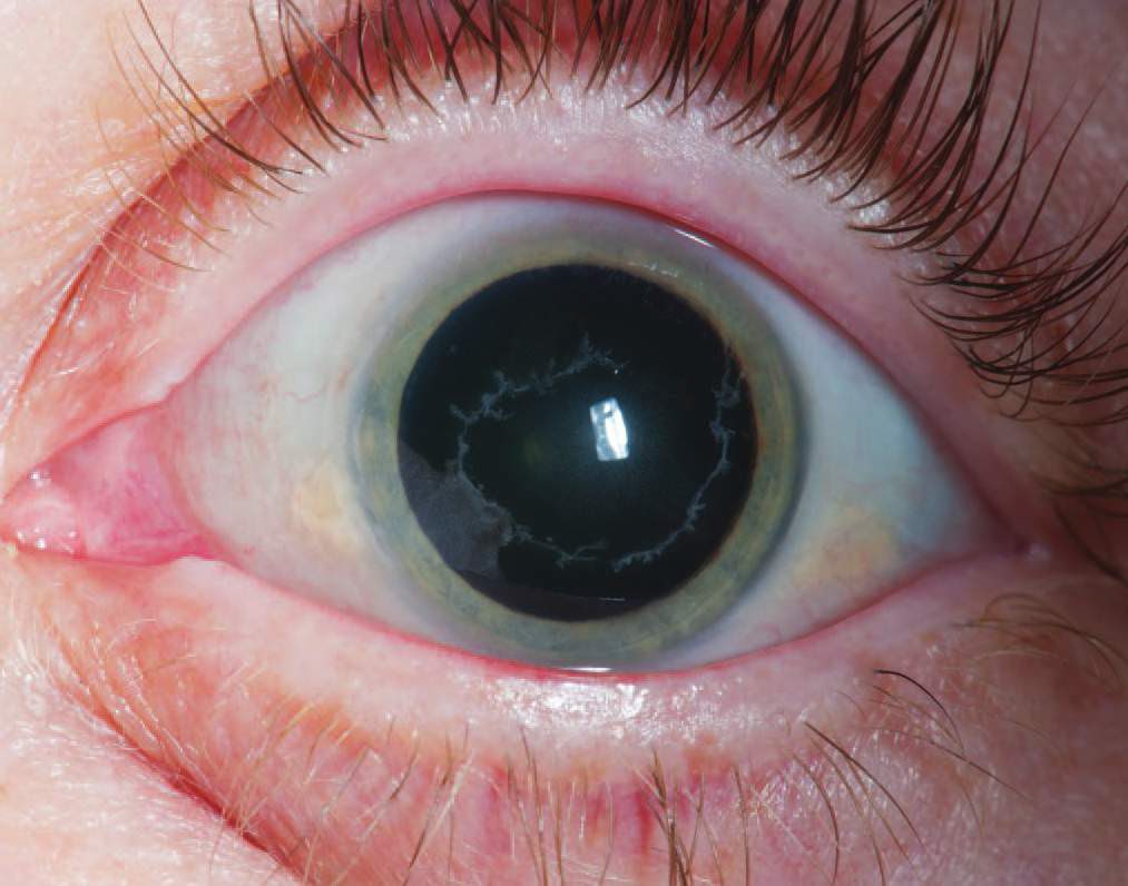 Study Medical Photos Herpes Zoster Opthalmicus